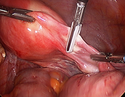 Laparoscopic Hysterectomy