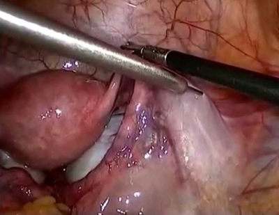 Laparoscopic Ovarian Cystectomy